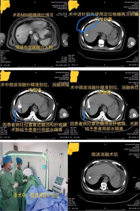 菏澤市立醫(yī)院介入科:開展微波消融術(shù) 造福腫瘤患者